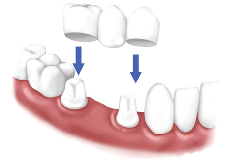 dent-crowns-2