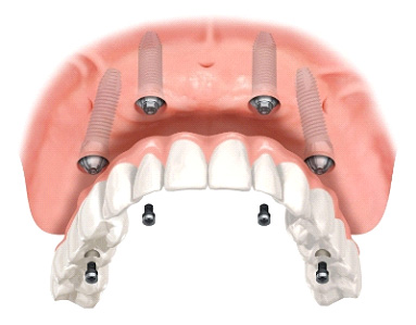 impl-3