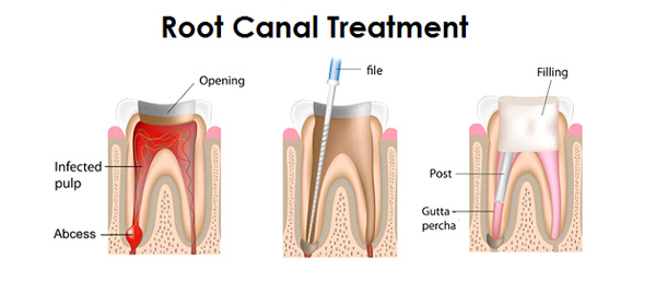 root